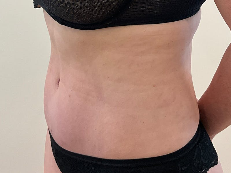 Tummy Tuck Before & After Gallery - Patient 288482 - Image 4