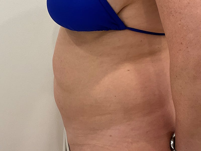 Tummy Tuck Before & After Gallery - Patient 288482 - Image 5