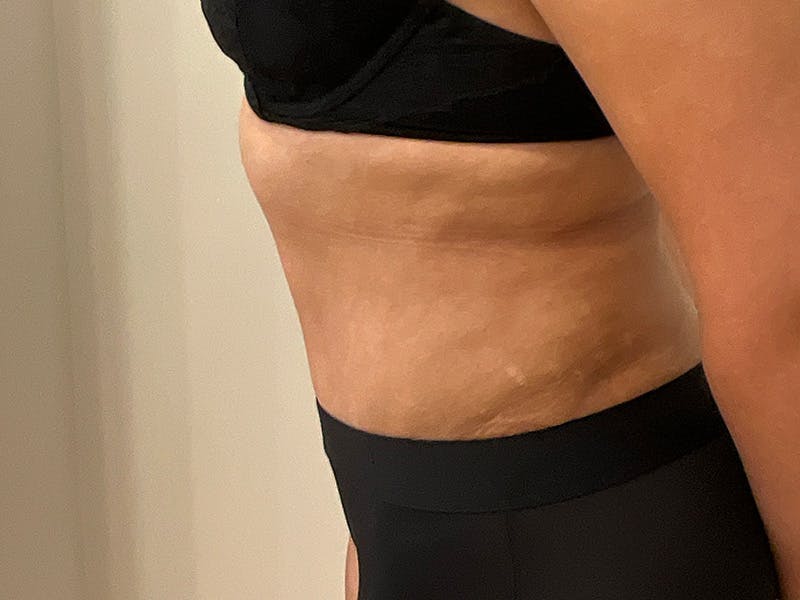 Tummy Tuck Before & After Gallery - Patient 366370 - Image 6