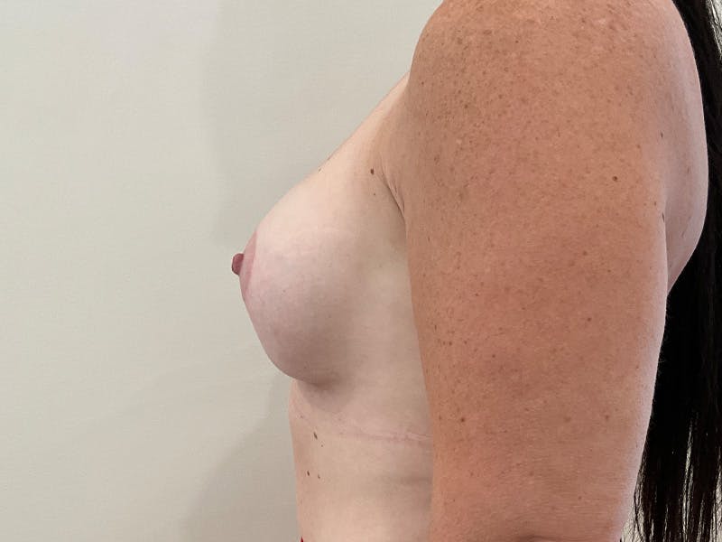 Breast Augmentation and Lift Before & After Gallery - Patient 302956 - Image 6