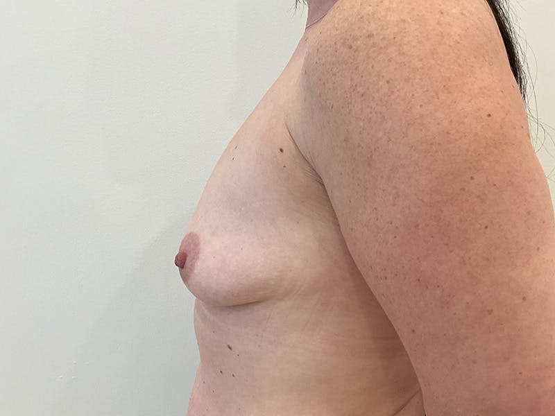 Breast Augmentation and Lift Before & After Gallery - Patient 302956 - Image 5