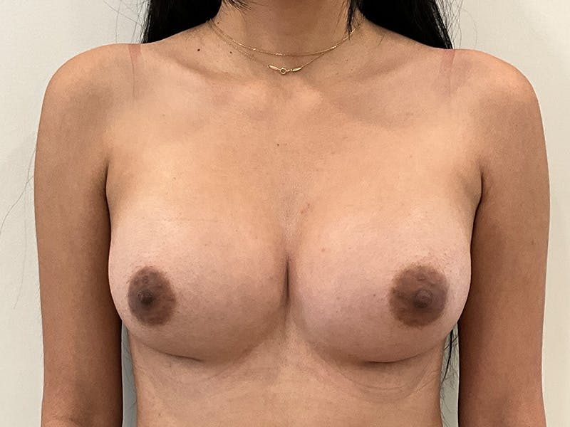 Breast Augmentation Before & After Gallery - Patient 313000 - Image 2