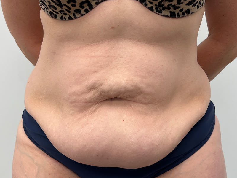 Tummy Tuck Before & After Gallery - Patient 363104 - Image 1