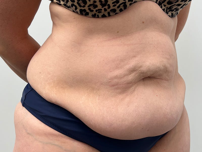 Tummy Tuck Before & After Gallery - Patient 363104 - Image 3