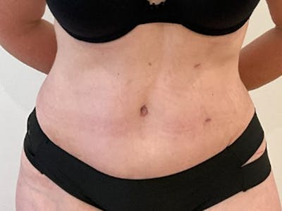 Liposuction Before & After Gallery - Patient 357818 - Image 2