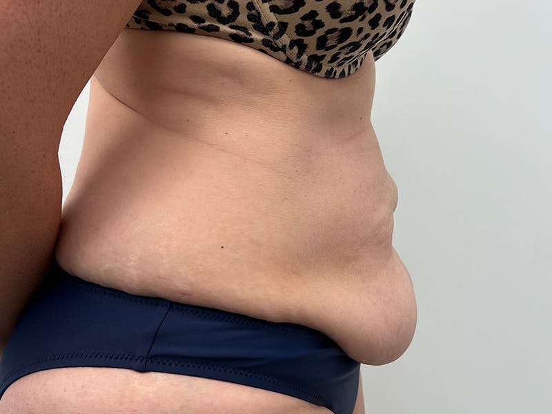 Tummy Tuck Before & After Gallery - Patient 363104 - Image 5