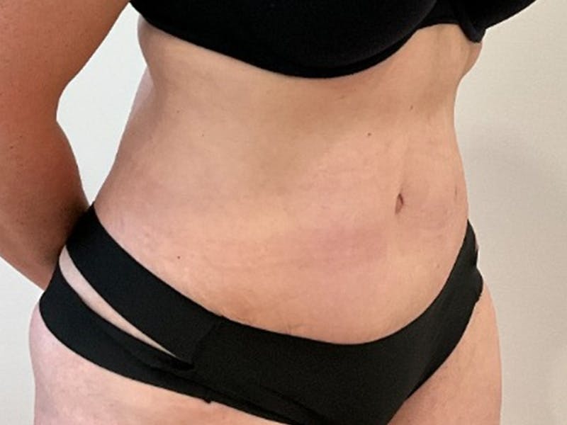 Tummy Tuck Before & After Gallery - Patient 363104 - Image 4