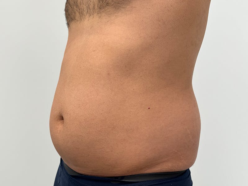 Liposuction Before & After Gallery - Patient 235158 - Image 3