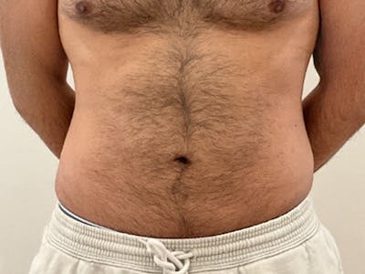 Liposuction Before & After Gallery - Patient 235158 - Image 2