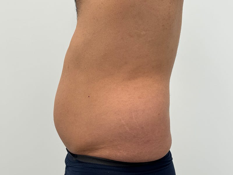 Liposuction Before & After Gallery - Patient 235158 - Image 5