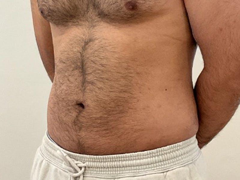 Liposuction Before & After Gallery - Patient 235158 - Image 4