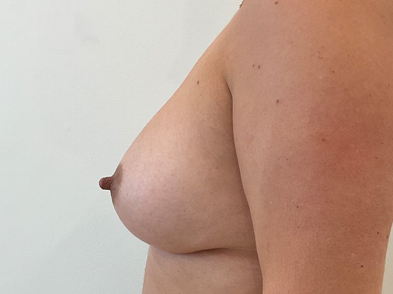 Breast Augmentation Before & After Gallery - Patient 322497 - Image 6