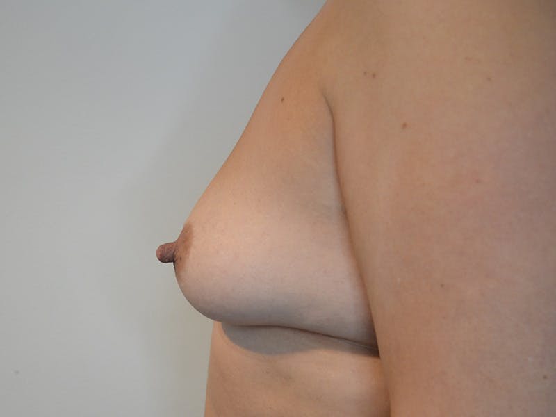 Breast Augmentation Before & After Gallery - Patient 322497 - Image 5