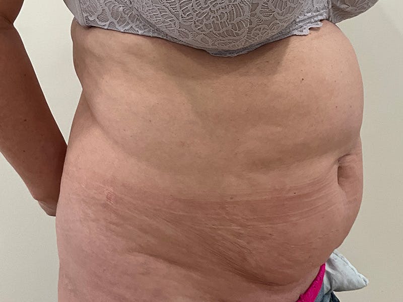 Tummy Tuck Before & After Gallery - Patient 368872 - Image 3