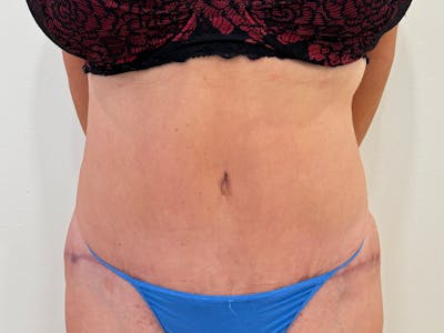 Liposuction Before & After Gallery - Patient 397493 - Image 2