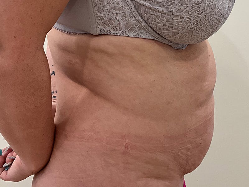 Tummy Tuck Before & After Gallery - Patient 368872 - Image 5