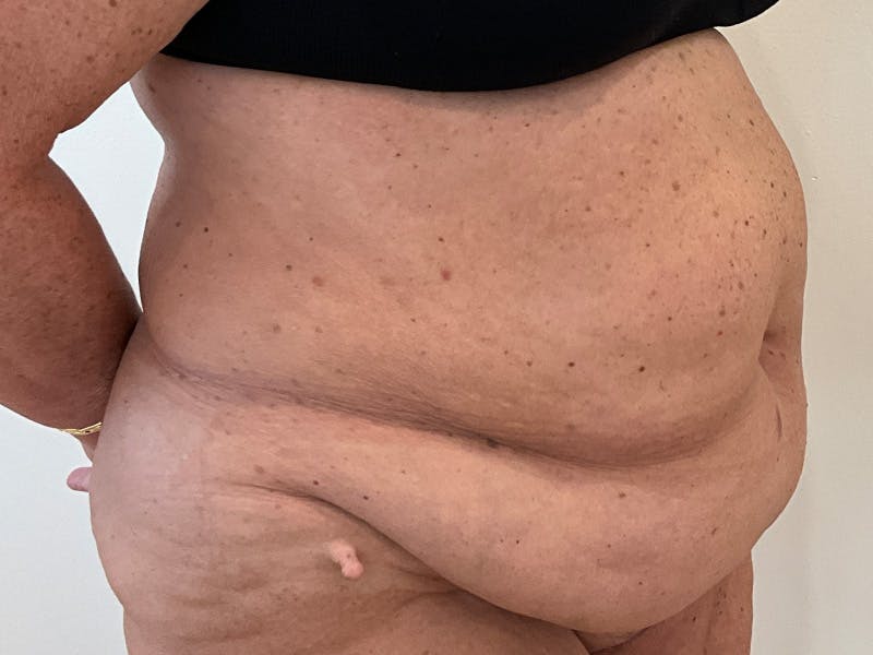 Tummy Tuck Before & After Gallery - Patient 113260 - Image 3