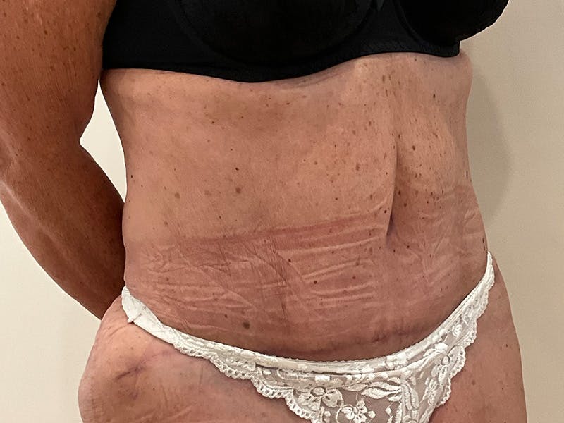 Tummy Tuck Before & After Gallery - Patient 113260 - Image 4