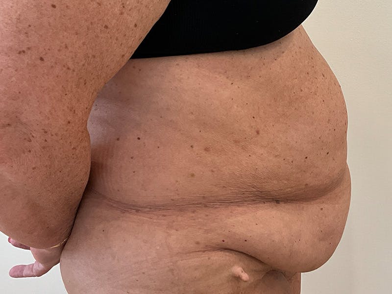 Tummy Tuck Before & After Gallery - Patient 113260 - Image 5