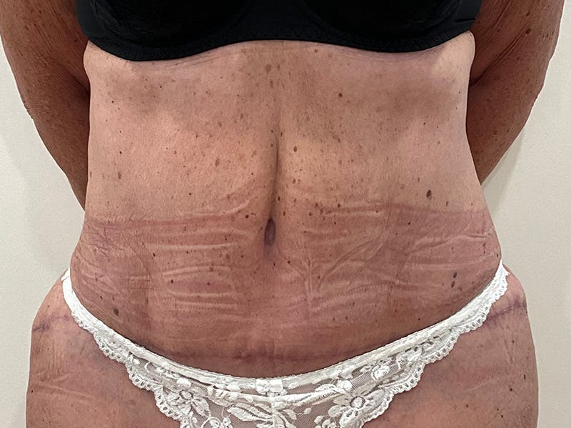 Tummy Tuck Before & After Gallery - Patient 113260 - Image 2