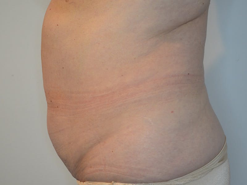 Tummy Tuck Before & After Gallery - Patient 228865 - Image 5