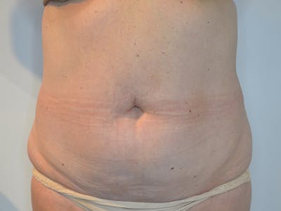 Liposuction Before & After Gallery - Patient 618271 - Image 1