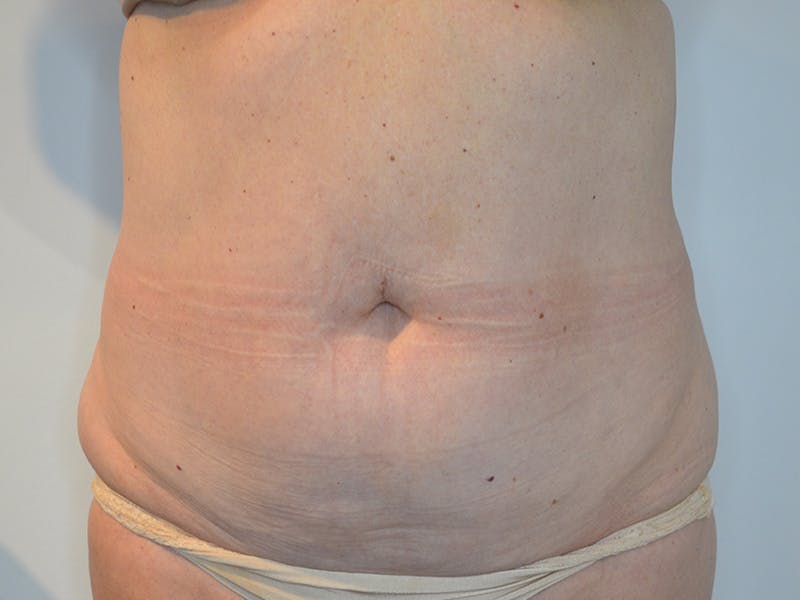 Tummy Tuck Before & After Gallery - Patient 228865 - Image 1
