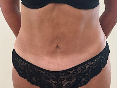 Liposuction Before & After Gallery - Patient 618271 - Image 2