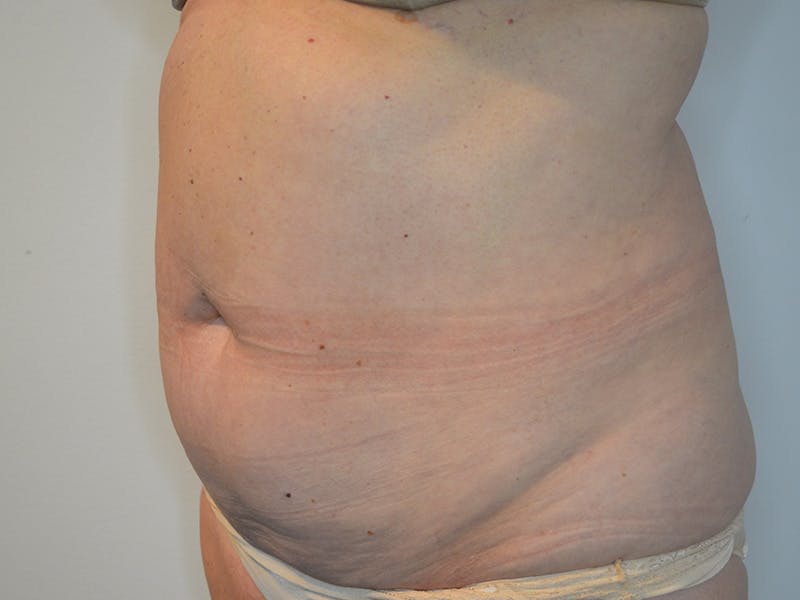 Tummy Tuck Before & After Gallery - Patient 228865 - Image 3