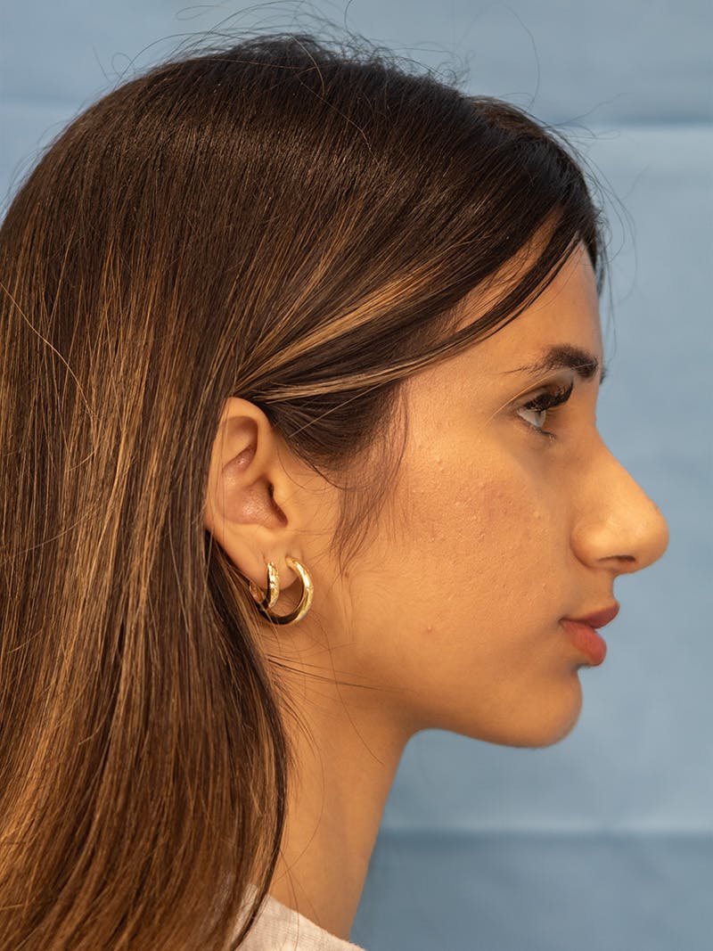 Rhinoplasty Before & After Gallery - Patient 201583 - Image 2