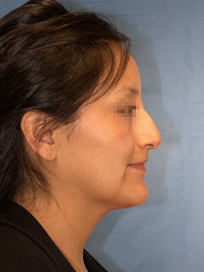 Rhinoplasty Before & After Gallery - Patient 889917 - Image 1