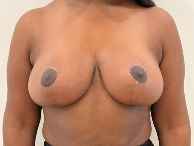 Breast Reduction Before & After Gallery - Patient 203665 - Image 2