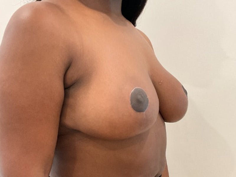 Breast Reduction Before & After Gallery - Patient 203665 - Image 4