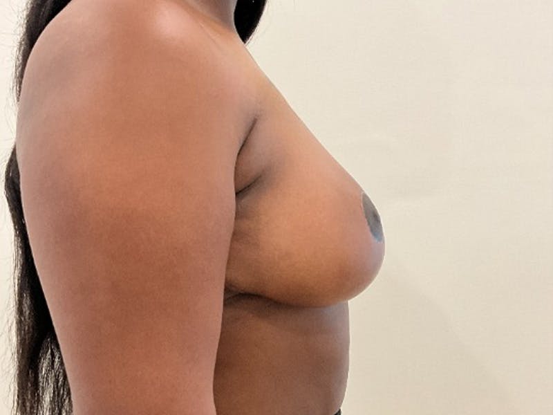 Breast Reduction Before & After Gallery - Patient 203665 - Image 6