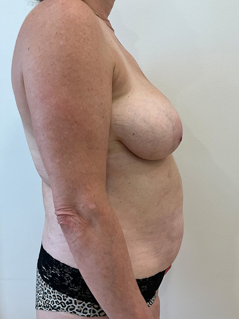 Mommy Makeover Before & After Gallery - Patient 201298 - Image 5