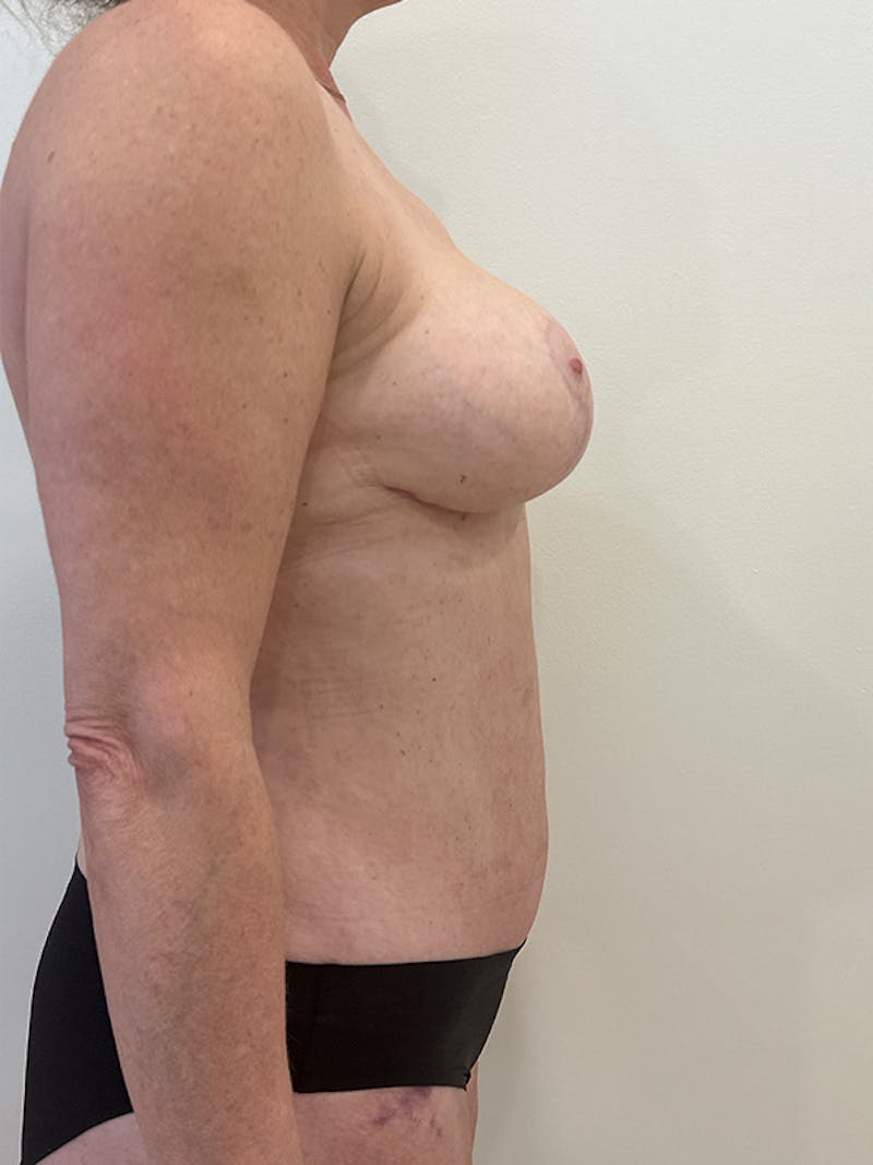 Mommy Makeover Before & After Gallery - Patient 201298 - Image 6