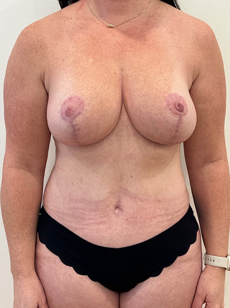 Mommy Makeover Before & After Gallery - Patient 186681 - Image 2
