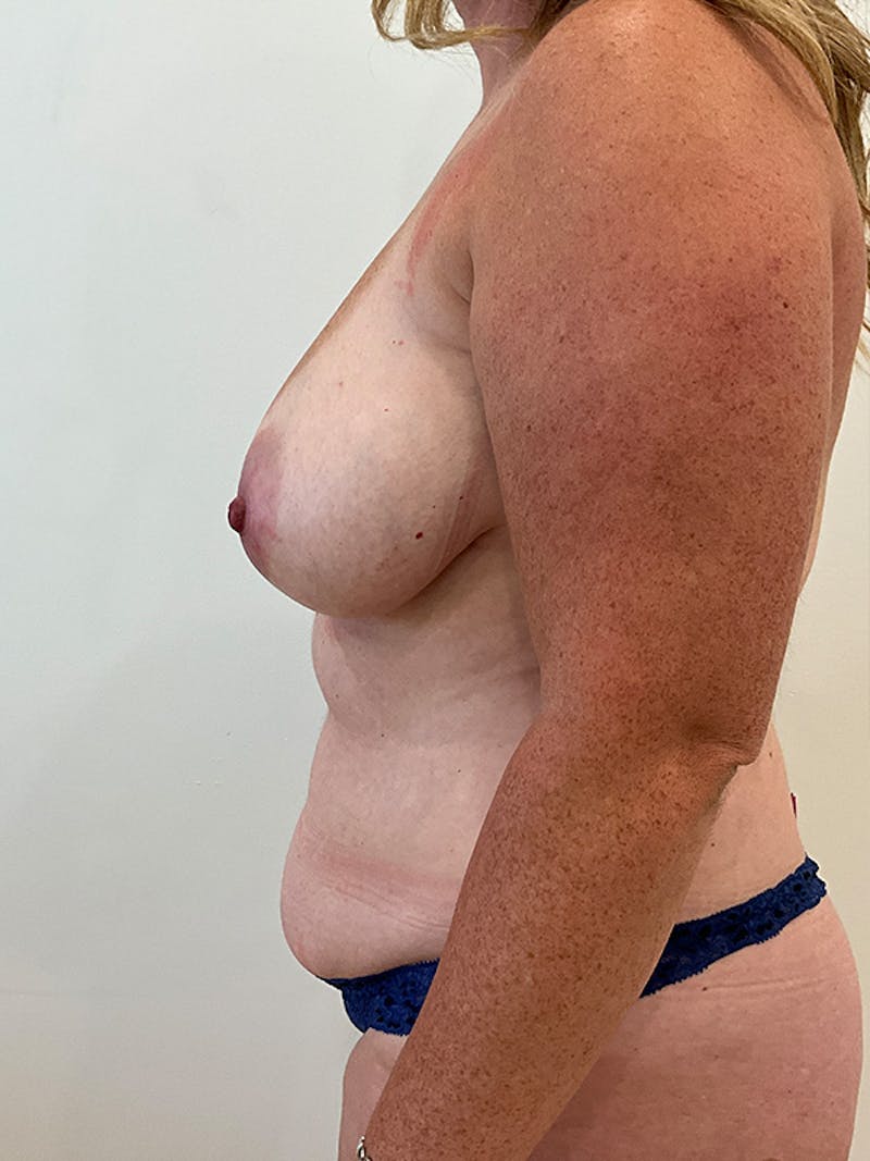 Mommy Makeover Before & After Gallery - Patient 186681 - Image 5