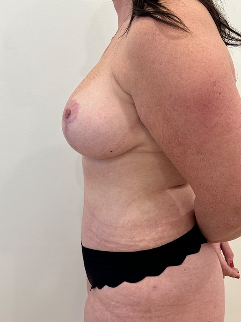 Mommy Makeover Before & After Gallery - Patient 186681 - Image 6
