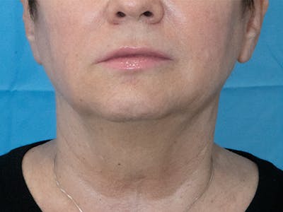 Neck Lift Before & After Gallery - Patient 297002 - Image 1