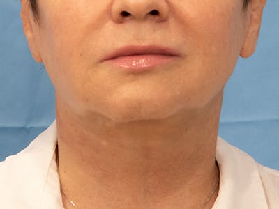 Neck Lift Before & After Gallery - Patient 297002 - Image 2