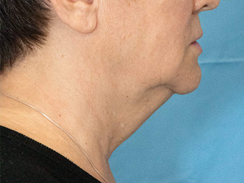 Neck Lift Before & After Gallery - Patient 297002 - Image 3