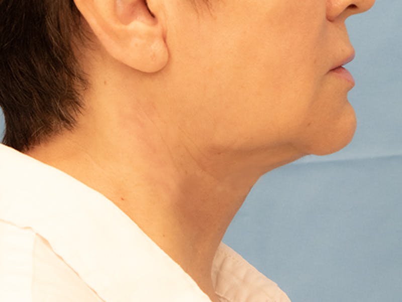 Neck Lift Before & After Gallery - Patient 297002 - Image 4