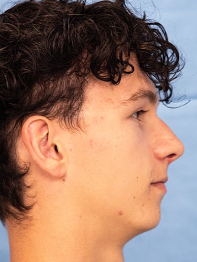 Rhinoplasty Before & After Gallery - Patient 305346 - Image 1
