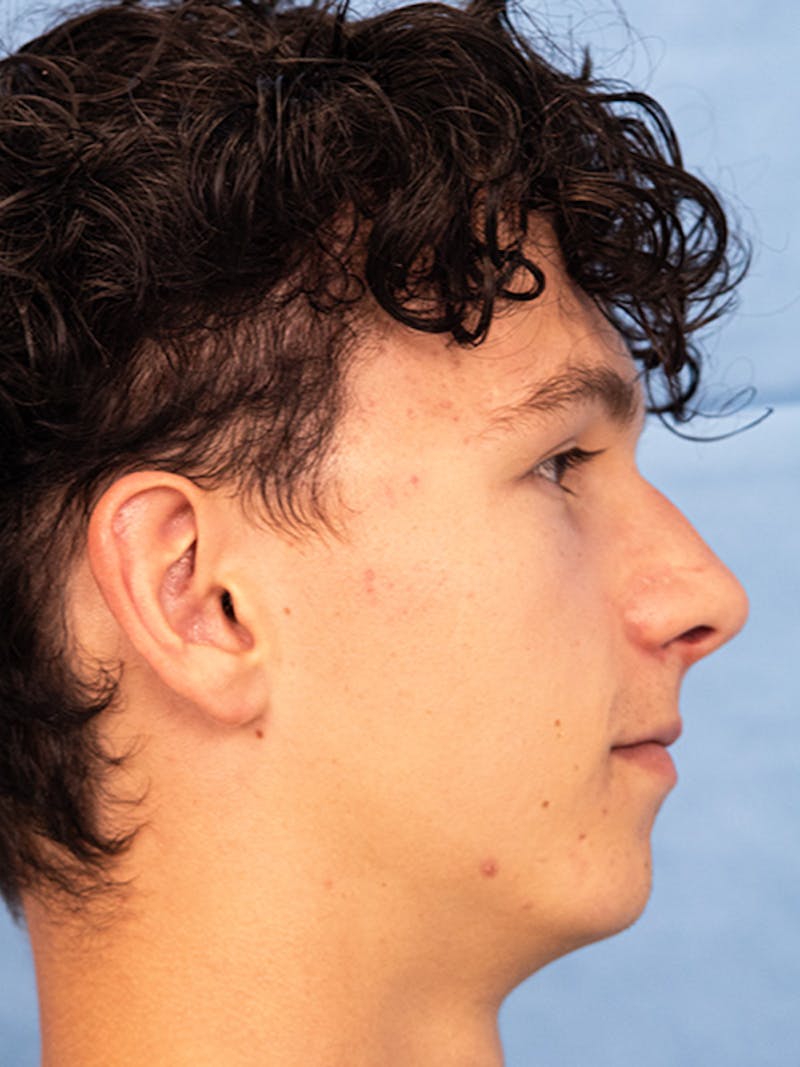 Rhinoplasty Before & After Gallery - Patient 305346 - Image 1