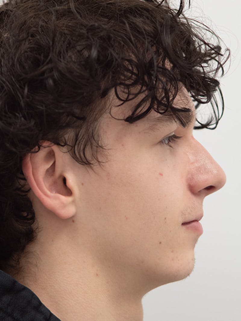 Rhinoplasty Before & After Gallery - Patient 305346 - Image 2