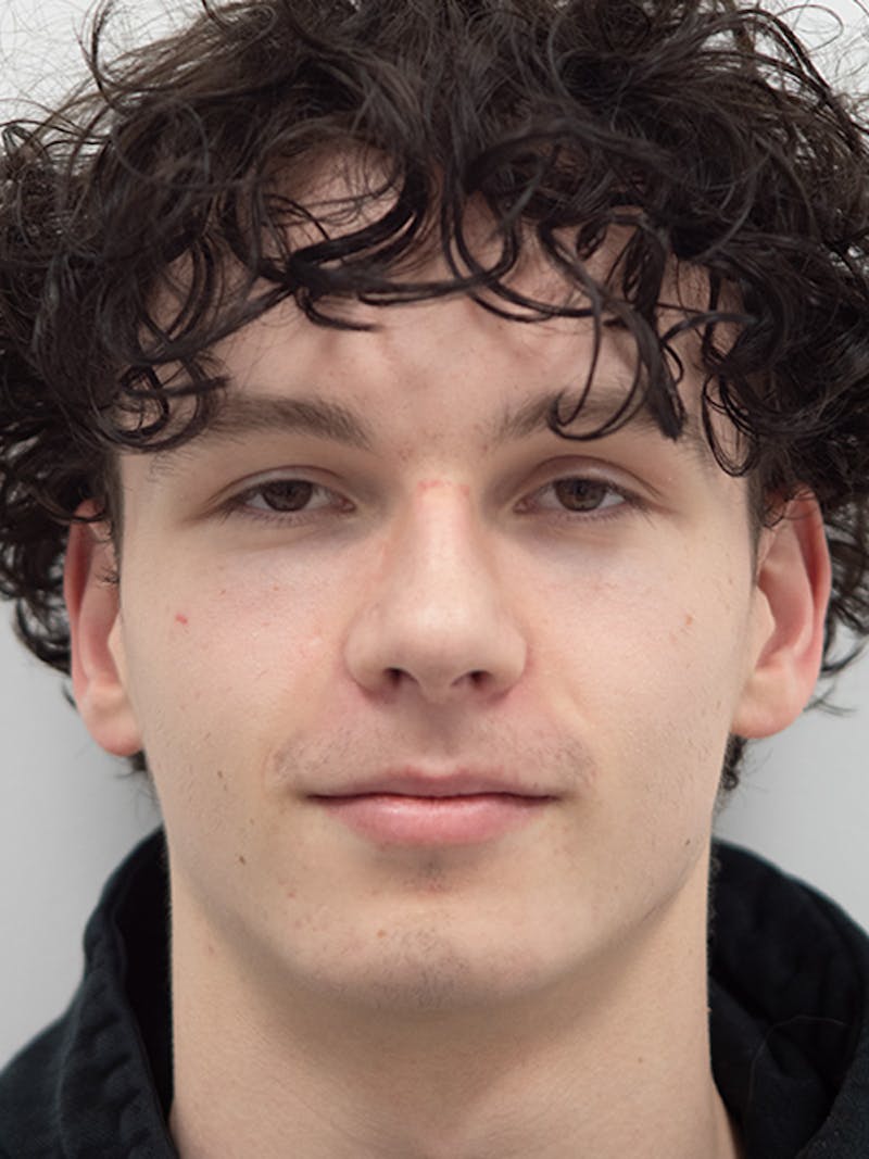Rhinoplasty Before & After Gallery - Patient 305346 - Image 4
