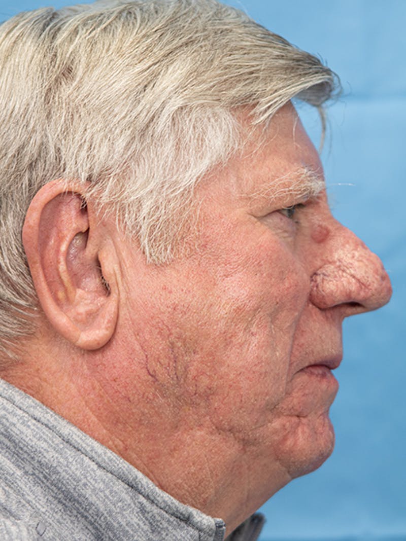 Rhinoplasty Before & After Gallery - Patient 158977 - Image 1