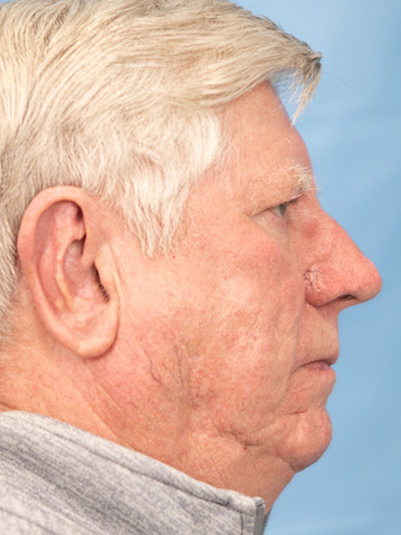 Rhinoplasty Before & After Gallery - Patient 158977 - Image 2