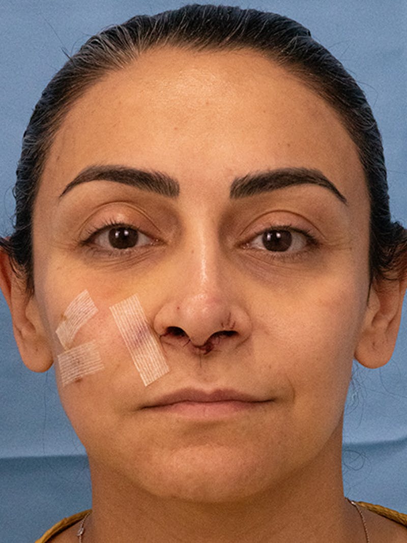 Rhinoplasty Before & After Gallery - Patient 253709 - Image 3